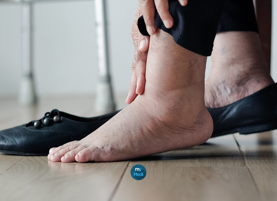 Pieds gonflés : les signes alarmants